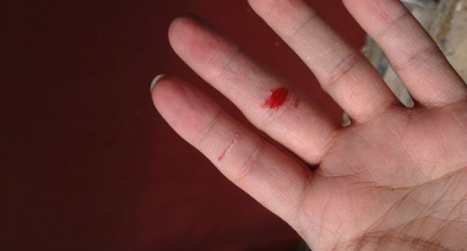Giải m&atilde; giấc mơ thấy bị đứt tay