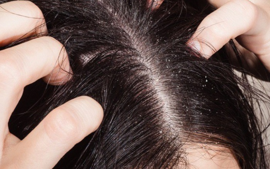 Mơ thấy đầu c&oacute; chấy c&oacute; &yacute; nghĩa g&igrave;?