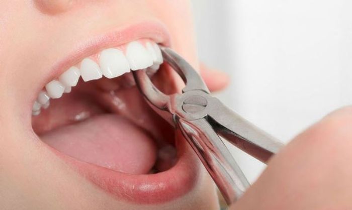 Mơ thấy nhổ răng c&oacute; &yacute; nghĩa g&igrave;?