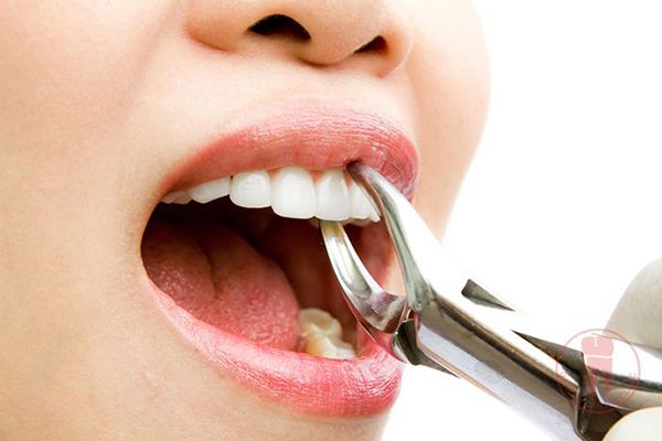 Nằm mơ thấy nhổ răng đ&aacute;nh đề con g&igrave;?
