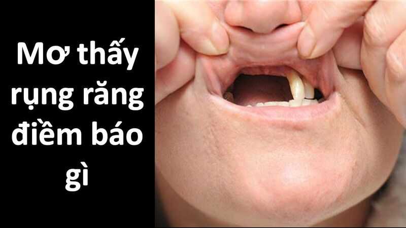 Giải mã giấc mơ rụng răng chứa điềm báo tốt hay xấu